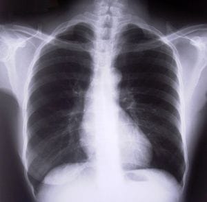 chest x-ray